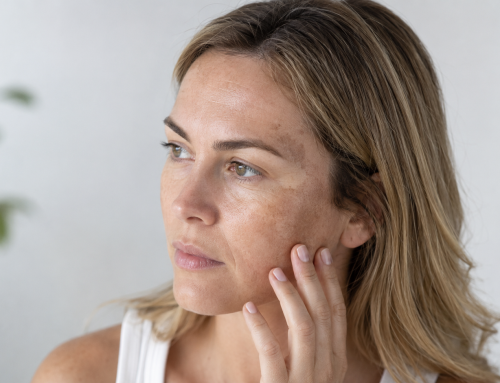 Hyperpigmentation – How the Doctor Treats It, How the Beautician Treats It